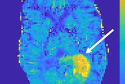2019 03 05 23 19 1033 7 T Mri Gliomas Paech 20190305233613