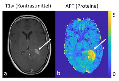 A conventional morphological contrast-enhanced 3-tesla MR image of a brain tumor (left) versus protein measurement using 7-tesla MRI (right). Images courtesy of Dr. Daniel Paech and European Radiology.