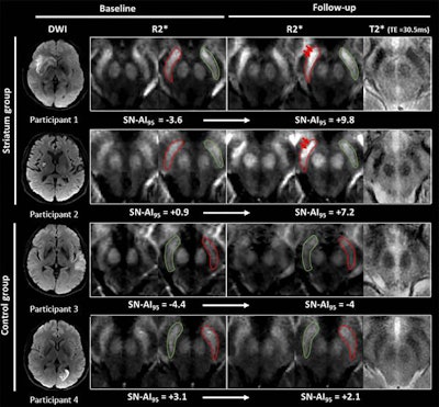 MR images show examples of visual R2* modifications within substantia nigra at baseline (24-72 hours after stroke) and at one-year follow-up in striatum (participants 1 and 2) and control groups (participants 3 and 4). Axial R2* maps are enlarged at mesencephalon level and one of the individual T2* echoes also is shown at follow-up. The substantia nigra is segmented in red ipsilateral to infarct and in green contralateral to infarct. Images without outlines are also shown. Brighter R2* spots are noted with red arrows. Asymmetry index of 95th percentile of R2* within substantia nigra (SN-AI95) measured in these participants is indicated for reference. Participants 1 and 2 show marked asymmetry of R2* within ipsilateral substantia nigra at follow-up, compared with baseline after infarct involving entire striatum (participant 1) or limited to putamen (participant 2). Asymmetry also is visible on individual T2* echo at follow-up. Conversely, no asymmetry was observed in participants 3 and 4 sparing striatum. Images courtesy of Radiology.