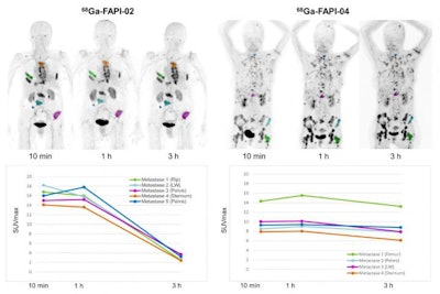 PET images of Ga-68 FAPI-2 and Ga-68 FAPI-4 were obtained at 10 minutes, one hour, and three hours after injection. Rapid tumor targeting and fast blood clearance are followed by a long plateau phase without relevant change in image contrast (top). In comparison with Ga-68 FAPI-2, Ga-68 FAPI-4 is characterized by a prolonged tumor retention time (bottom). LW = lumbar body. Images courtesy of Giesel et al and the J Nucl Med.