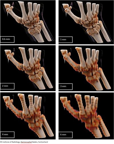 Figure 1. Reconstruction in bone window with different slice thicknesses; medium image quality. All images courtesy of Dr. Diana Kreul.