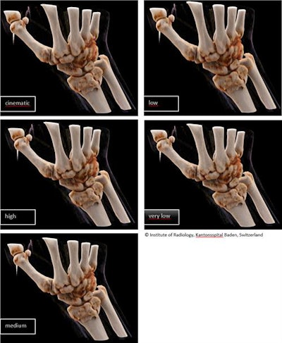 Figure 2. Reconstruction in bone window for the same slice thickness (1 mm) with different image quality levels.