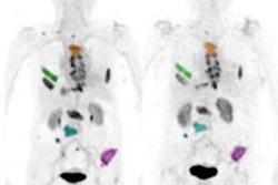 2019 03 21 17 40 0193 Pet Ct Fapi Cancer Jnm 20190321171439