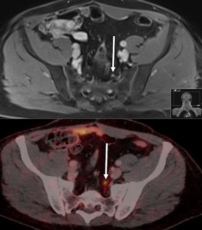 Images from a 55-year-old patient with biochemical recurrence of prostate cancer following radical prostatectomy four years previously. His PSA rose to 0.51 ng/mL at the time of imaging. PSMA-PET CT (bottom) identified a 5-mm small lymph node metastasis due to the pathologic PSMA uptake in the left presacral region (maximum standardized update value of 6.1). The lymph node was falsely rated as nonmalignant on MRI based on its small size and ovoid shape. Images courtesy of Sawicki et al.