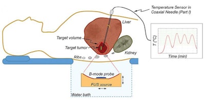 Diagram showing the treatment concept. In the first six participants, target temperature was monitored with a thermometry device implanted through a coaxial needle; for the other four participants, no thermometry device was used. Image courtesy of Michael Gray, PhD, et al, Radiology.