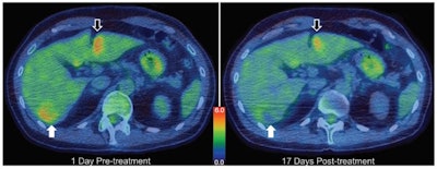 Treatment planning, modeling, and example results from a 50-year-old man with diffuse multilobular hepatocellular carcinoma in segment VI. Axial F-18 FDG PET/CT images obtained one day before (left) and 17 days after (right) treatment. Total lesion glycolysis of target tumor (white arrows) decreased by 36.4%, whereas there was no substantial change over the volume of a similarly sized tumor that received drug but no focused ultrasound (black arrows). Color bar indicates standardized uptake value. Images courtesy of Michael Gray, PhD, et al, Radiology.