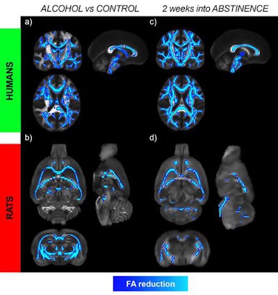 Microstructural changes in white matter in human alcoholics (a) and alcohol-exposed rats (b) were measured using DTI-MRI to provide an index of microstructural integrity. The changes further progress after two weeks of abstinence in both species, as seen in (c) the humans and (d) rats. The results challenge the current view that alterations in the brain begin to normalize immediately after quitting alcohol and indicate that persistent brain deficits can occur much earlier than is currently believed. Images courtesy of Silvia De Santis, PhD.