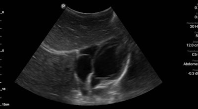 Ultrasound scan of a pediatric male's heart demonstrates normal-appearing cardiac activity without evidence of pulmonary hypertension. Courtesy of L. Nolting et al, J Ultrasound Med, 10.1002/jum.14923.