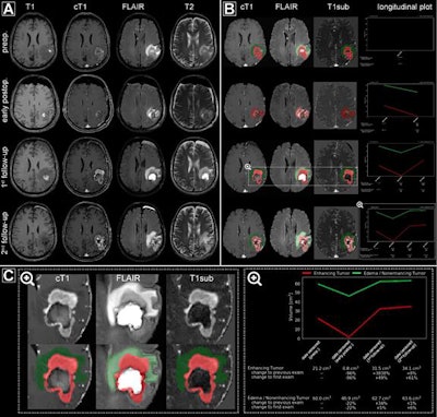 Automated processing of multiple MRI exams (preoperative, early postoperative, first follow-up, and second follow-up) from a representative patient. (A) Regular MRI sequences acquired as part of the clinical routine. (B) The automated processing pipeline generates a semitransparent superimposed tumor segmentation mask on the individual MR sequences and a chart depicting the longitudinal volume dynamics for both contrast-enhancing tumor and nonenhancing T2 signal abnormality (C, magnified). They are automatically pushed back to the PACS where they are available for interpretation. Image courtesy of the department of neuroradiology at Heidelberg University Hospital.