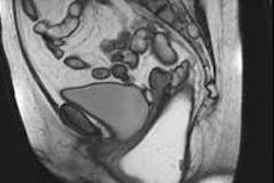 2019 04 16 17 45 5046 Pelvic Rectocele 225