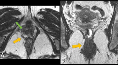 Static axial (A) and coronal (B) T2-weighted MR images allow the identification of structural defects, as disruption of right puborectalis muscle (yellow arrows) and loss of H-shaped vagina on the right side (green arrow). Images courtesy of Dr. Patrícia Costa. © Hospital Pedro Hispano, Hospital Pedro Hispano - Matosinhos/PT.