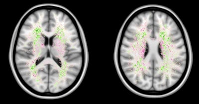 These images show a spatial distribution of the false-negative white-matter hyperintensity segmentations of a human observer and the top 4 ranking methods in the WMH Segmentation Challenge