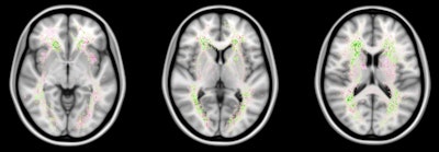 False negatives are the most common source of error for both humans and computers. The images show a spatial distribution of the false-negative white-matter hyperintensity segmentations of a human observer and the top 4 ranking methods in the WMH Segmentation Challenge. The colors indicate the differences. Green means that the top 4 methods had fewer false negatives, while pink means that the human observer had fewer false negatives. Overall, the top 4 AI methods had fewer false negatives than a human observer, but the AI methods made more mistakes at locations where lesions are rarely found. Images courtesy of Hugo Kuijf, PhD.