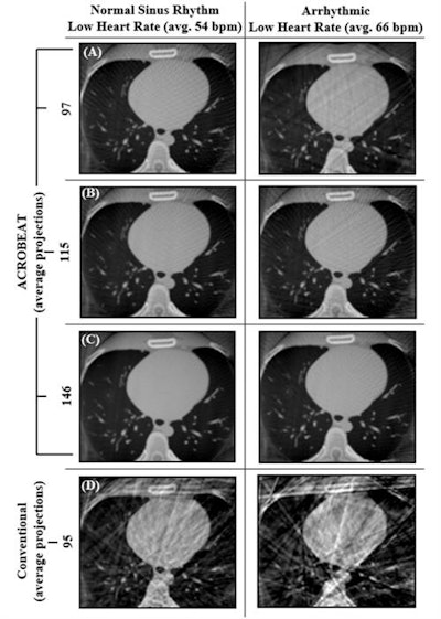 Reconstructed cardiac-gated 3D images for acquisition windows of 60% to 70% through the cardiac cycle for ACROBEAT, with an average of 97 (A), 115 (B), and 146 (C) projections; and conventional multisweep retrospective gated protocol (D) with 95 projections. Image courtesy of Reynolds et al, Phys Med Biol, 10.1088/1361-6560/ab03f4.