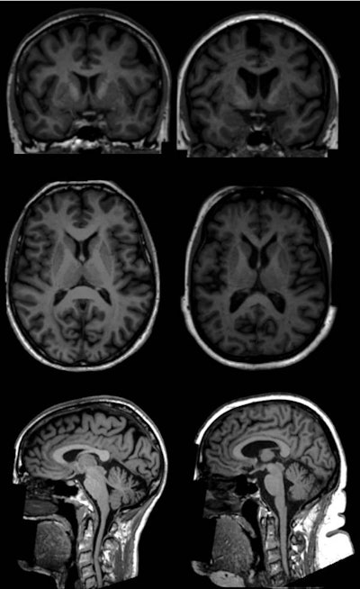 T1-weighted brain MR images show examples (coronal, top; axial, middle; and sagittal, bottom) of two women (age 65) in the U.K. Biobank study. One subject has a body fat percentage of 13% (left), while the other woman has a body fat percentage of 49% (right). MR images show lower volumes of subcortical gray-matter structures in the individual with higher total body fat percentage (right). Images courtesy of Radiology.