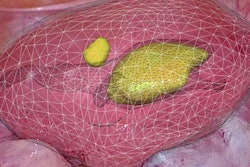 2019 04 26 17 35 5483 Ar Adenomyoma 20190426174619