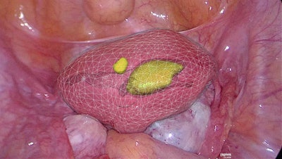 Augmented reality displaying a 3D model of an adenomyoma overlaid on top of the patient anatomy. Image courtesy of Dr. Nicolas Bourdel, PhD.
