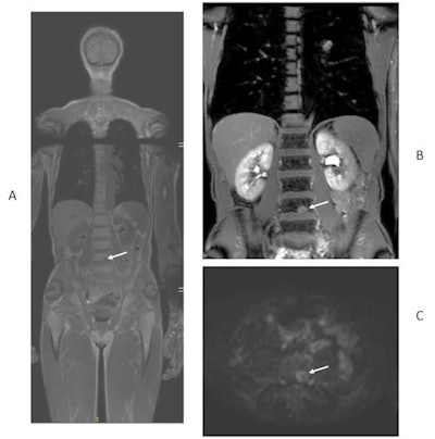 49-year-old man with newly diagnosed lung cancer recruited to Streamline L trial. Whole-body MRI revealed a solitary L4 bone metastasis that was occult on standard imaging, including CT and PET/CT. A = coronal T1-weighted image. B = contrast-enhanced T1-weighted image. C = axial diffusion-weighted image. Figure courtesy of Prof. Stuart Taylor.