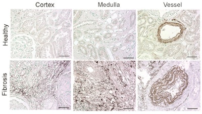 Using the ESMA MRI technique, the researchers identified that elastin is overproduced in diseased kidneys (bottom row) compared with healthy kidneys (top row). Image courtesy of Sun et al, Science Translational Medicine.