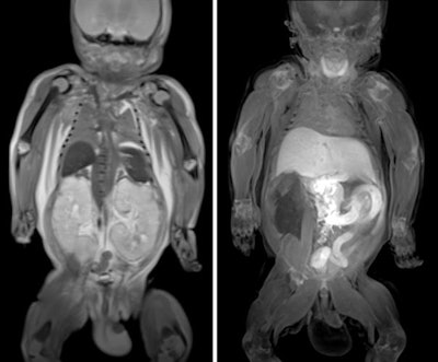 Body postmortem fetal MRI. Coronal T2-weighted (left) and T1-weighted (right) images from a 33-week fetus with autosomal recessive polycystic kidney disease and pulmonary hypoplasia. T2-weighted images demonstrated the enlarged kidneys and hypoplastic lungs (left), and T1-weighted images showed the normal high T1-weighted signal in the thyroid, meconium in the colon, and high T1-weighted signal in the liver (right). Courtesy of Norman W et al. Perinatal and pediatric postmortem magnetic resonance imaging (PMMR): sequences and technique. Br J Radiol. 2016;89(1062). doi:10.1259/bjr.20151028.