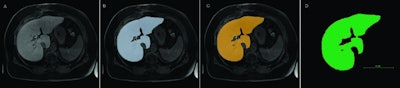 The graphic shows the segmentations of an MRI scan (A) with the manual (B) and the automatic variant (C). Panel D illustrates the comparison between manual and fully automatic segmentation. The green pixels indicate the areas of concordance, while the red pixels represent the areas of deviation. Image courtesy of Dr. Niklas Verloh.