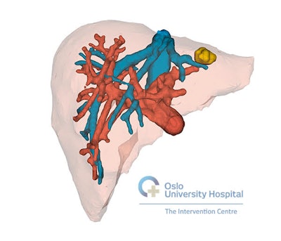 3D liver model visualized through AR technology. Image courtesy of Dr. Egidijus Pelanis.
