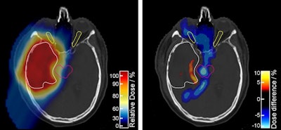 The proton treatment plan based on the DirectSPR method (left) results in substantially reduced dose to healthy tissue compared with a plan based on conventional lookup tables (dose difference map, right). Image courtesy of OncoRay/Christian Hahn, Nils Peters.