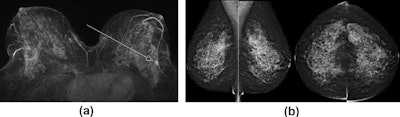 Screening MRI and mammogram in a 45-year-old woman with the BRCA2 mutation. (a) Maximum-intensity projection, contrast-enhanced, subtracted T1-weighted MRI shows a stippled background enhancement with a 10-mm type III enhancing nodule in the left lower outer quadrant. (b) Mammography demonstrates dense tissue and benign nodularity, which is essentially normal. Mastectomy revealed a 14-mm grade II invasive lobular carcinoma. Images courtesy of Gibson et al and Clinical Radiology.