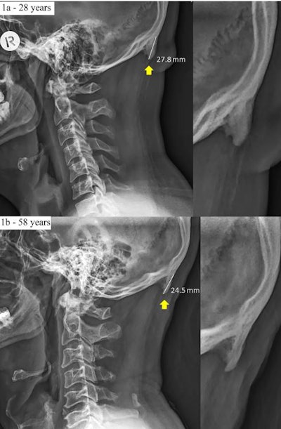 Example radiographs of two male participants (28 years old and 58 years old) presenting with large enthesophytes emanating from the occipital squama. These images also include the enthesophyte measurements used throughout this study. Image courtesy of David Shahar and Mark Sayers. Licensed under CC BY 4.0.
