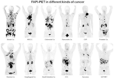 Ga-68 FAPI PET/CT in patients shows 12 different tumor entities. Ca = cancer; NSCLC = non-small cell lung cancer; CUP = carcinoma of unknown primary; CCC = cholangiocarcinoma; GEP-NET= gastroenteropancreatic neuroendocrine tumor. Images courtesy of Kratochwil et al and SNMMI.