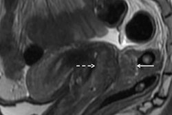 2019 06 27 17 36 2569 Freeman Mri Endometriosis 20190627174806