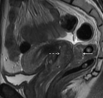 A 34-year-old woman with dyspareunia and dyschezia. This sagittal T2-weighted image through the pelvis reveals a large endometriotic deposit within the rectovaginal septum. The mass has an 'hourglass' configuration and is infiltrating the posterior vaginal fornix anteriorly (dashed arrow) and the rectal muscularis posteriorly (solid arrow). The nodule represents fibromuscular hyperplasia around ectopic endometrial glands. There is commonly preservation of the overlying rectal mucosa, seen as a high signal intensity (bright) line overlying the mass. Endometriotic infiltration of the muscle dictates a different surgical approach than the presence of adhesions or serosal involvement alone. Image courtesy of Dr. Susan Freeman.