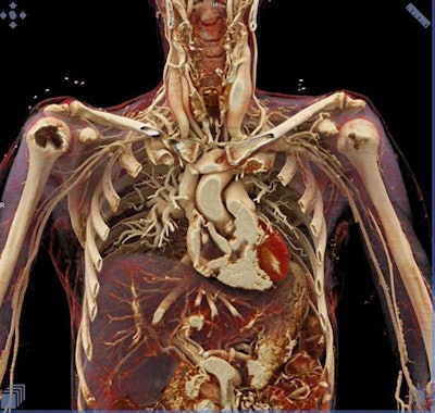 Cinematically rendered chest CT angiography scan.