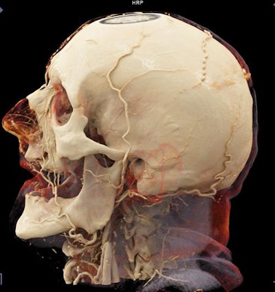 Cinematically rendered head CT angiography scan of a deceased patient. All images courtesy of Dr. Emmanuel Coche, PhD.