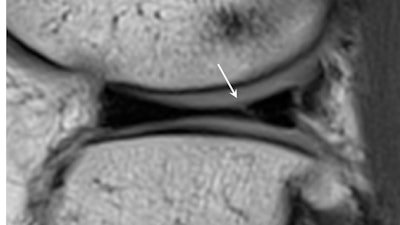 When reporting presigning imaging, it is important to identify small and often asymptomatic meniscal tears, particularly in the load-bearing regions of the meniscus. As in this case of a tear of the posterior horn of the lateral meniscus seen on presigning imaging (above), these tears can extend and displace, producing pain and locking requiring resection (below). All images courtesy of Dr. Andrew Dunn.
