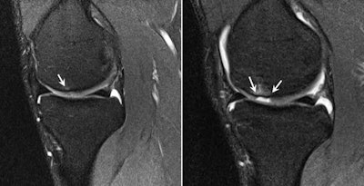 The presigning MRI screen identified focal subchondral bone marrow edema on the weight-bearing surface of the medial femoral condyle with overlying chondral high signal abnormality (left) and a subtle oblique full-thickness chondral fissure. The player presented with medial joint line pain and new effusion in the second week of preseason training. Subsequent MRI (right) showed progression of the chondral fissure into a well-defined and displaced full-thickness chondral defect with new subchondral bone marrow edema.
