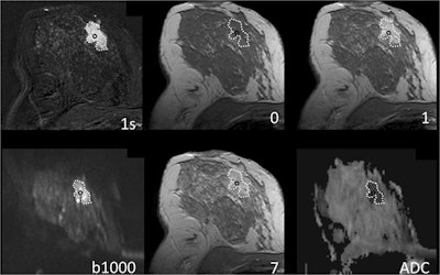 Breast MRI of a 41-year-old woman with grade 2 invasive ductal cancer. Numbers denote acquisition time points of T1-weighted dynamic gradient-echo images after intravenous contrast medium injection in minutes (0 = precontrast acquisition). '1s' equals first subtraction. The dotted line delineates the lesion from the surrounding breast parenchyma. The lesion is depicted as an ill-defined mass with fast initial-phase enhancement and washout during the delayed phase. The region of interest to extract the diagnostic information used in this work is highlighted by a black circle. Images courtesy of Profs. Matthias Dietzel and Pascal Baltzer and European Radiology.