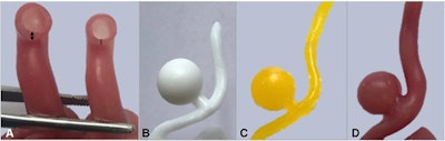 A: 3D-printed model of the middle cerebral artery composed of three layers of silicone (double-sided arrow) and two layers of silicone (single line). B, C, and D: 3D-printed model for simulating cerebral aneurysm repair. All images courtesy of Nagassa et al and licensed under CC BY-NC 4.0.