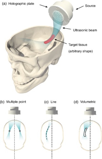 Diagram shows the holographic lens focusing over the right hippocampus. Image courtesy of S. Jiménez-Gambín et al, Phys Rev Applied (2019).
