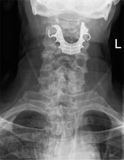 Anteroposterior neck radiograph of the 72-year-old man. Image courtesy of BMJ Case Reports 2019.
