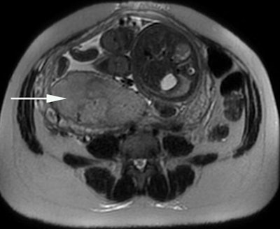 Placental oxygenation can be assessed by the blood oxygen level-dependent (BOLD) MRI technique, using T2* mapping (below) and combining a morphological analysis (above). The placenta is localized posteriorly on the right (arrow). The T2* value within each pixel is encoded with a color scale. Images courtesy of Prof. Nathalie Siauve.