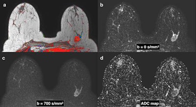 Breast images obtained with DWI in a patient with a triple-negative subtype cancer in the left breast. (a) Corresponding slices from dynamic contrast-enhanced (DCE) postcontrast image, (b) DWI at b = 0 s/mm2, (c) DWI at b = 700 s/mm2, (d) apparent diffusion coefficient (ADC) map. Invasive tumors show reduced diffusivity on DWI, appearing hyperintense on b = 700 s/mm2 image (c) and hypointense on the ADC map (arrows) (d). All images courtesy of Dr. Julia Camps-Herrero and BJR | Open.
