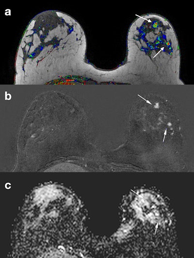 Same patient as in previous figure. Corresponding slices from (a) DCE postcontrast image, (b) DCE subtraction image, (c) ADC map. Two BI-RADS 4 lesions (arrows) were identified in a different quadrant from the index tumor. ADC characterized them as malignant (ADC = 1.28 x 10-3 mm2/sec). An MR-guided vacuum-assisted biopsy was performed in the largest of the two lesions, and an additional multicentric invasive ductal cancer was confirmed.