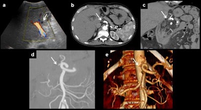 Anastomotic thrombosis. Artery thrombosis, the most serious complication of orthotopic liver transplantation, can be demonstrated as an absence of flow on Doppler ultrasound (a). CT can depict the thrombus and also the absence of distal flow (b). Multiplanar reconstructions and volume rendering images can be useful to ensure diagnosis (c-e). All images courtesy of Dr. Juan-José Delgado-Moraleda and Insights into Imaging.