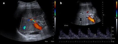 After treatment control. Control performed after thrombolysis and angioplasty of patient in previous figure. Normal arterial flow is seen. Resistive index shows normal values (0.6).