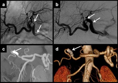 Multiplanar and 3D curved reformatting are useful to measure the vessel lumen in cases of multifocal stenosis of the hepatic artery. Each stenosis should be treated separately. In this case, angiography demonstrated two points of stenosis (a, b). Two stents were placed for treatment. Control CT showed that stents had been correctly placed. Distal artery flow is shown in the maximum intensity projection reconstruction (c) and in the volume-rendered reconstruction (d).