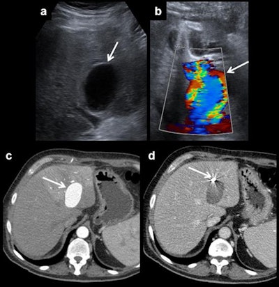 Hepatic artery pseudoaneurysm. Pseudoaneurysms can be discovered using ultrasound (a). It shows a characteristic appearance on Doppler ultrasound due to the turbulent forward and backward flow (b). Arterial phase CT shows arterial enhancement of the pseudoaneurysm (c). A coil is placed to block entry to the bloodstream and to prevent rupture (d).