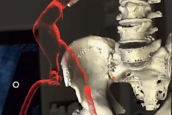 2019 08 28 17 11 7382 Ar Aneurysm Thumb