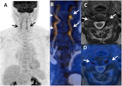 PET and MR images show the initial diagnosis of giant cell arteritis (GCA) in a female with temporal headaches and acute-phase proteins that can cause inflammation but no vascular signs or join pain (arthralgia). There is an inflammatory pattern with clear FDG uptake in vertebral arteries in maximum intensity projection (A) and fusion MR angiography/PET (B) (arrows), which is associated with arterial wall thickening on axial T2-weighted MR image (C) and T2-weighted/PET fusion (D). Images courtesy of Scientific Reports.