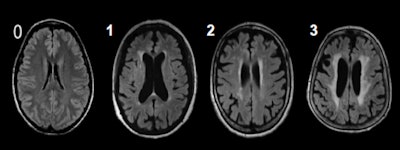The Fazekas scale is a system for describing white-matter disease severity. It can quantify the amount of white-matter T2 hyperintense lesions attributed to chronic small vessel ischemia. Image courtesy of Dr. Tina Stegmann.